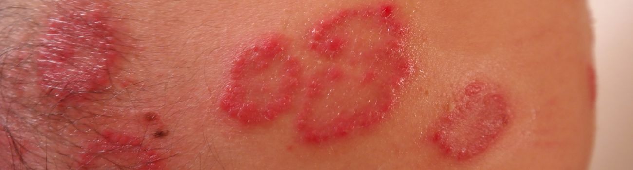 Czas na dermatologa czyli co zrobić w razie wysypki