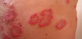 Czas na dermatologa czyli co zrobić w razie wysypki