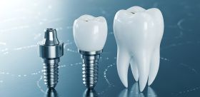 Ile kosztują implanty stomatologiczne – i gdzie zrobić niezbędne badania przed zabiegiem?
